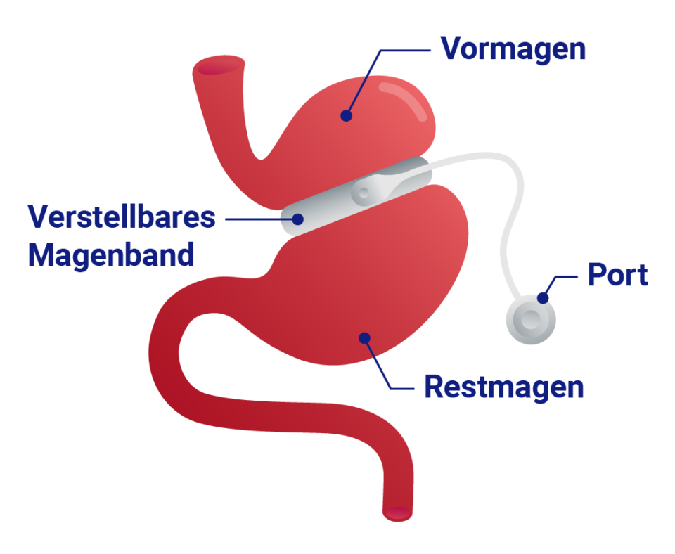 Grafik Magenband