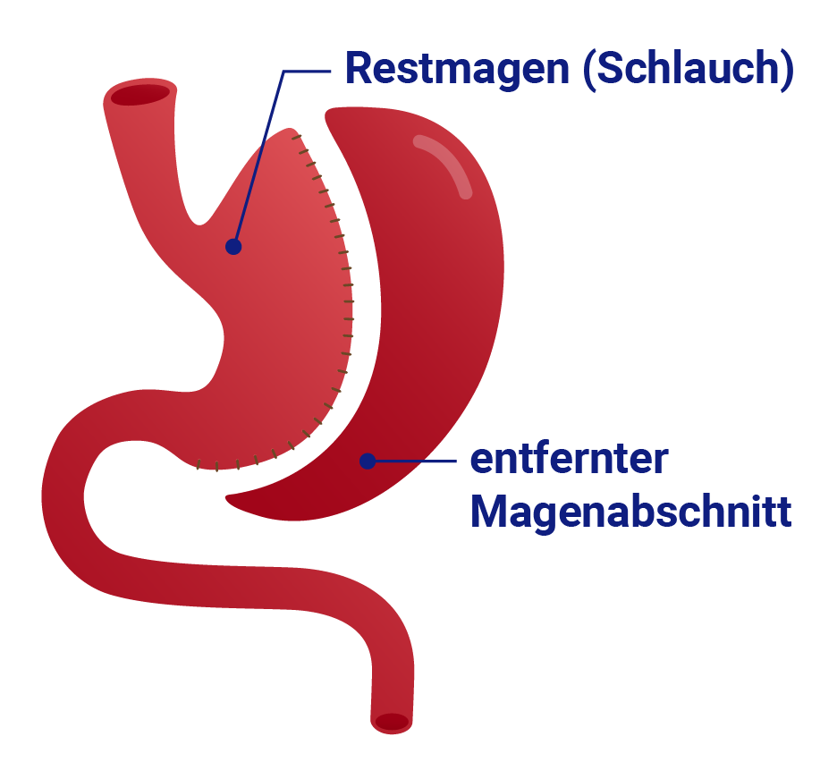 Grafik: Schlauchmagen